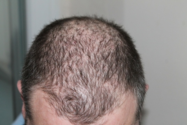 Perte de cheveux