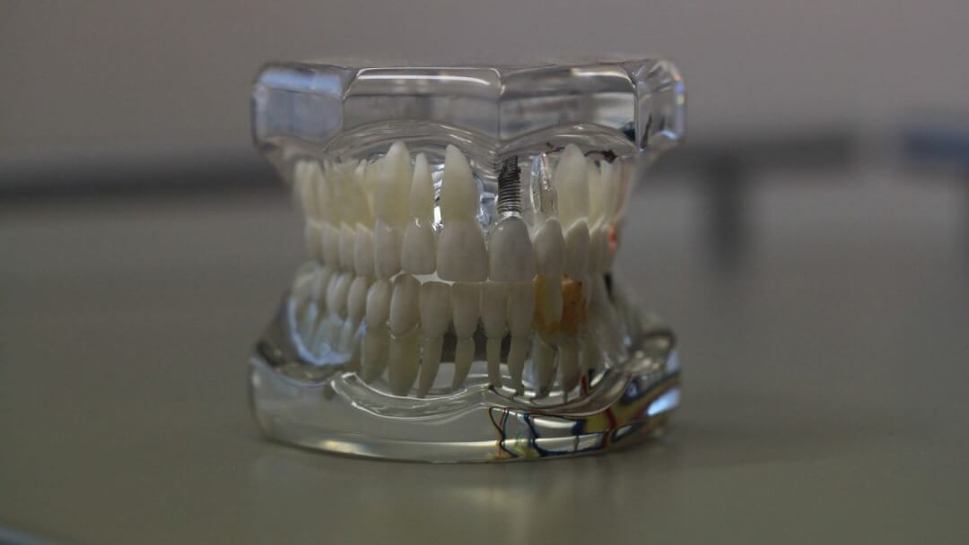 l&rsquo;impression 3d en médecine pour réduire les coûts de production des prothèses